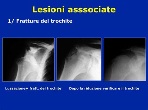 PPT - Lussazioni di spalla PowerPoint Presentation, free ...