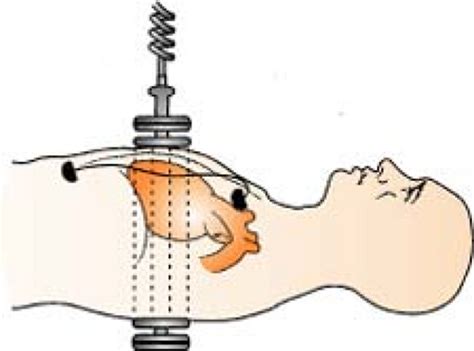 Position paddles on patient and apply correct pressure. Cardiovascular System | Anesthesia Key
