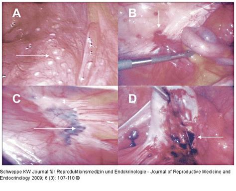 Bei endometriose treten zysten und entzündungen weil endometriose sich ganz unterschiedlich zeigen kann, ist sowohl die diagnose als auch die behandlung schwierig. Abbildung 1: Endometriose