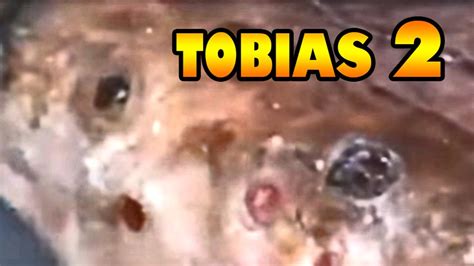 We have 8 images about giant jiggers youtube including images, pictures images wallpapers, and more. Tobias' Big Jigger Popping! Pt2 - Tungiasis Awareness ...