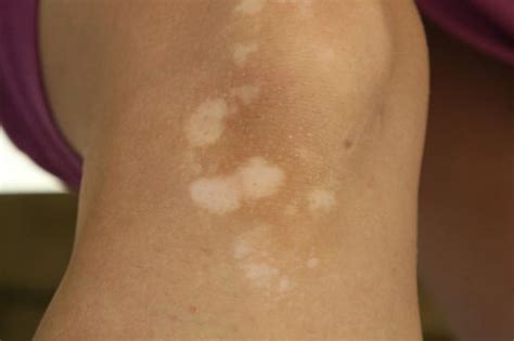 Check spelling or type a new query. Tinea Versicolor Diet: Foods to Eat and Foods to Avoid