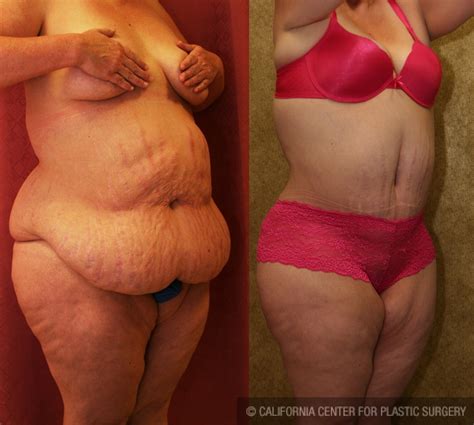 Alibaba.com offers 854 after baby girdle products. Patient #5888 Tummy Tuck Plus Size Before and After Photos ...