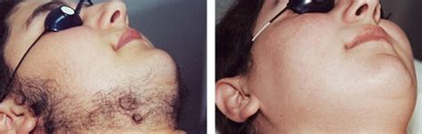 Laser hair reduction, beverly hills. Laser Hair Removal Beverly Hills, Los Angeles