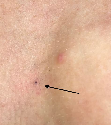 Adam mamelak discusses tattoo skin care concerns and the danger of skin cancer with these cover ups. Just radiotherapy to go