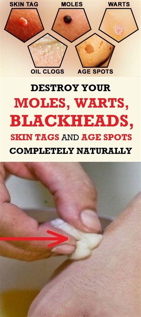 Massy aasani say khatam karny ka tariqa How To Easily Remove Skin Tags, Moles, Blackheads, Spots ...