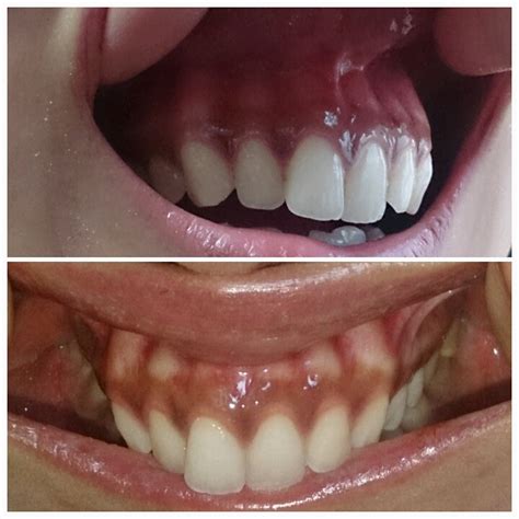 木下矯正歯科 mikio kinoshita orthodontic office. 写真あり かくれ出っ歯の歯列矯正について | 歯チャンネル ...