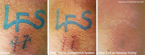 Laser tattoo removal is safe. LFS-01 - Vanish Laser Clinic Alexandria VA