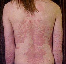 Psoriasis is often a lifelong condition. Psoriasis - Wikipedia, the free encyclopedia