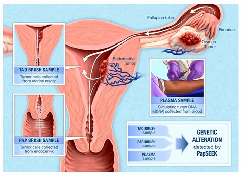 They may be used alone or in combination depending on tumor volume, spread pattern, and figo staging. Could a pap test spot more than just cervical cancer?