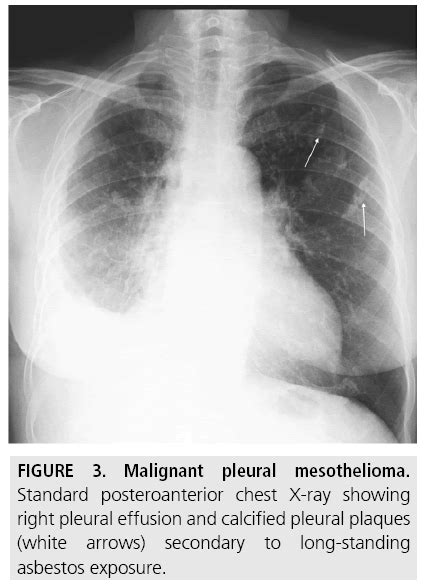These are the typical features of mesothelioma. Diagnostic imaging and workup of malignant pleural ...