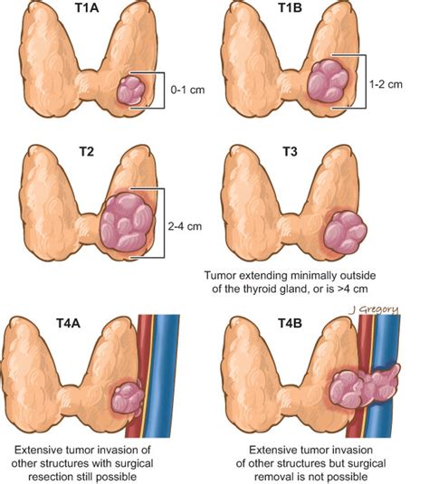 The earlier medullary thyroid cancer is found, the more likely it can be stopped and treated. Medical Malpractice Verdict Affirmed in Delayed Cancer ...