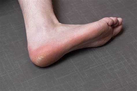 See full list on wikihow.com How To Get Rid Of Dead Skin On Feet - 6 Home Remedies Must Try