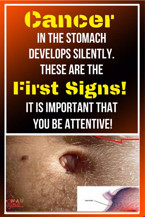 Because these symptoms tend to be dismissed as normal gi issues — and they are for most people — when stomach cancer is finally diagnosed, it's often in the advanced. Cancer In The Stomach Develops Silently. These Are The ...