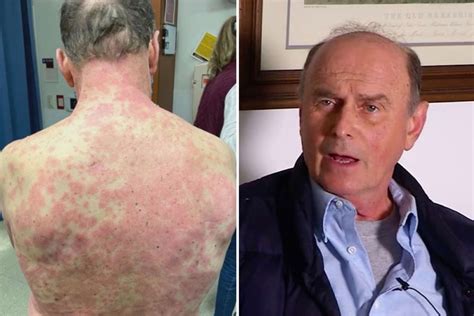 On march 10, president joe biden announced his intent to. Man, 74, gets 'rare' severe rash all over body and says ...