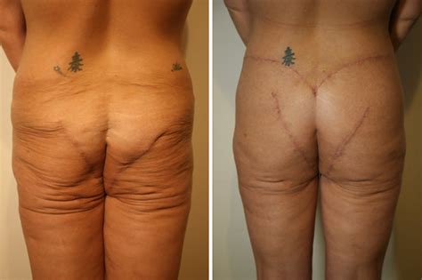 If you're constantly sitting and never exercising, then your buttocks might get smaller, but only because the muscle would be replaced with fat. Botched bum lift leaves woman with saggy bottom that is so ...