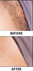 Electrolysis can you from tweezing, waxing or shaving unwanted facial hair or body hair, so that you can feel confident everyday. Laser Hair Removal - OU Beauty Medical Spa