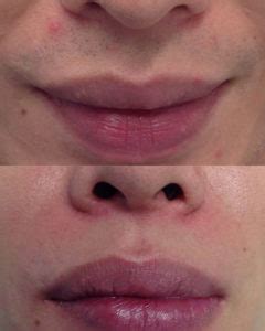 All in (minus your personal expenses), you can expect a single laser hair removal treatment to cost $125 to $1,000. Laser Hair Removal - Upper Lip | Australian Skin Clinics