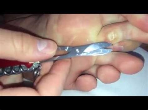 How to remove calluses naturally. Extreme Toe Callus removal - YouTube