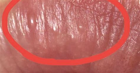 Eine geschwollene zunge kann verschiedene ursachen haben. BITTE HILFE! :(Kleine blasen auf Lippe was tun? (Blase ...