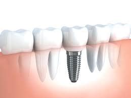 Gigi palsu jenis ini digunakan jika semua gigi anda hilang. Ketahui Macam Jenis Gigi Palsu Atau Tiruan Yang Bisa Anda ...