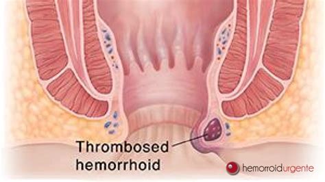 O diagnóstico é feito por inspeção ou anuscopia. Arquivos Dicas sobre Hemorroida | Hemorroidurgente