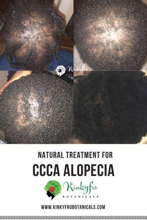 Predominantly seen in black women and women who wear tight or damaging hair styles the hair loss pattern typically leaves peach fuzz or fully bald areas in the frontal region and temporal areas (front corners. CCCA Alopecia Treatment. All Natutural Ingredients ...