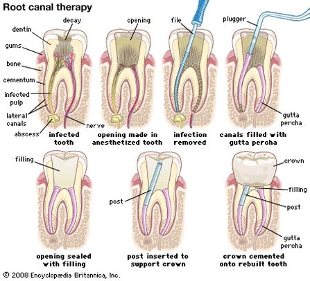 We did not find results for: Root Canal Treatment - White Plains Dental Care