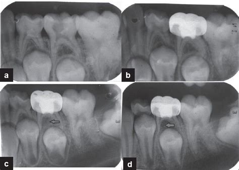 Caries do not have to develop significantly before they reach the pulp chamber. Periapical xrays - show the entire tooth, including the ...