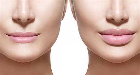 There are products available which can dissolve hyaluronic acid fillers, so the effects of these fillers are not only temporary, but they can be reversed, if necessary. Can Lip Fillers Be Taken In Pregnancy--Dr. Hillary Taggart ...