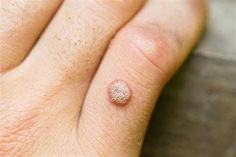 You can smear the healthy skin with petroleum jelly so. Understanding the Different Types of Wart Treatments ...