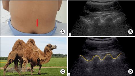 Cute the way you say standard. A camel-hump sign of the lumbar articular process in a ...