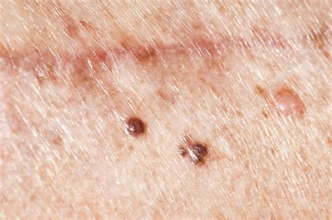 Learn about melanoma symptoms, such as suspicious moles, and find out about melanoma treatments, including surgery, radiation therapy and immunotherapy. Metastatic melanomas - Stock Image - C050/6873 - Science ...