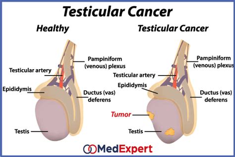 Although this type of cancer can occur in men the aches and pains and lumps and bumps that may actually be the first signs of a medical emergency are often ignored or regarded as something. Testicular Cancer | MED Expert