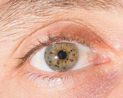 After heart disease, it is the second most common cause of death in the united states. Do Eye Freckles Mean Cancer - The Millennial Mirror
