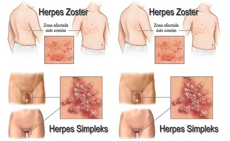 The viruses are transmitted through contact with an infected person's lesion, mucosal surface. Obat herpes genitalis (kelamin) pada wanita - Obat herpes herbal