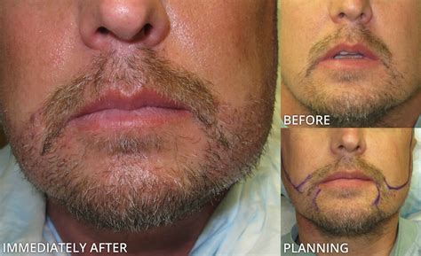 At ann arbor plastic surgery, we offer hair restoration and facial, breast, and body enhancement procedures including rhinoplasty, facelift, breast augmentation, liposuction, tummy tuck, and labiaplasty surgeries. Facial Hair Transplant - Before and After Pictures * | Dr ...