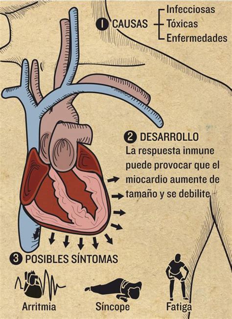 Myocarditis or inflammatory cardiomyopathy is inflammation of heart muscle 1 although the etiology of myocarditis often remains undetermined, a large variety of. Miocarditis | Magazine 05-2013 | Infografía salud #miocarditis #myocarditis #health (con ...