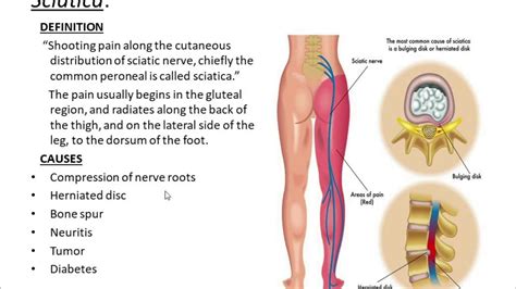 Sciatica • it is a term applied to a clinical condition defined by shooting pain felt along the course of distribution of the sciatic nerve (example. Sciatic Nerve Explained - YouTube