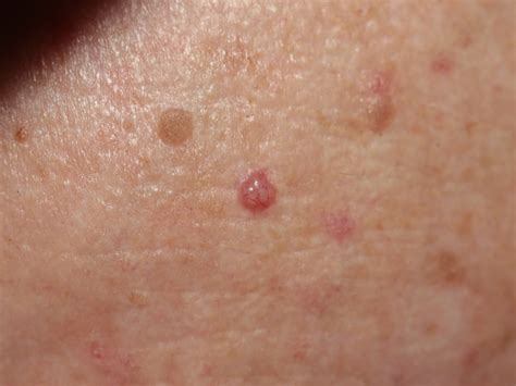 Advanced basal cell carcinoma (bcc) can look different on everyone. Basal Cell Carcinoma - Causes, Types, Symptoms, Prognosis ...