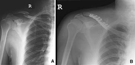 Anterior-inferior plating of middle-third fractures of the ...