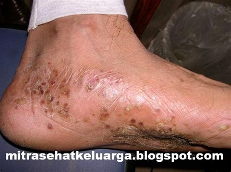 Aug 18, 2020 · terlebih jika kulit kering disebabkan oleh reaksi alergi, sebaiknya hindari kontak dengan bahan yang dapat memicu alergi tersebut sebagai cara alami mengatasi kulit kering pada tangan dan kaki. Cara Mudah Mengatasi Gatal Kering Menahun Di Kaki | Apotik ...