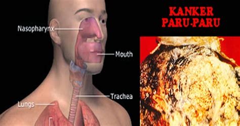 Rokok maupun asap rokok mengandung lebih dari 60 zat beracun yang dapat memicu perkembangan kanker (karsinogenik). Cara Mengatasi Berbagai Macam Penyakit: Cara Mengatasi ...