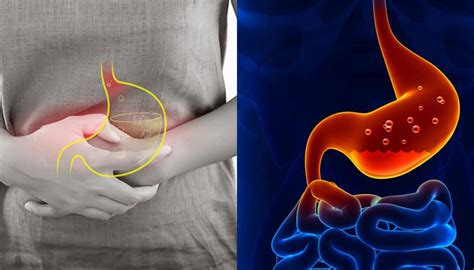 Minuman beralkohol, terutamanya bir dan minuman yang dimasak dengan fruktosa juga boleh meningkatkan kandungan asid urik dalam darah. Jika Anda Mengalami 5 Tanda Penyakit Gastrik Ini Dalam ...