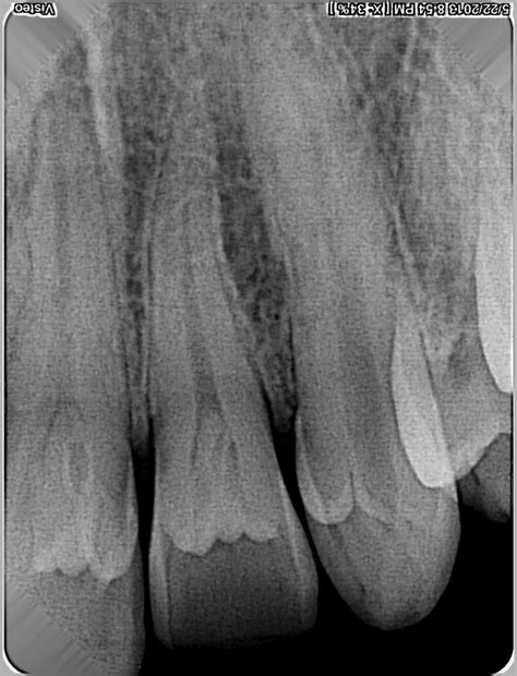A rare presentation of multiple dens invaginatus in maxillary dentition ...
