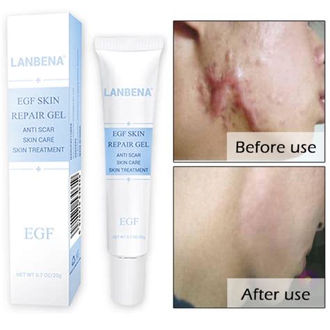 Pimple marks removal cream scar removal cream acne scar removal hair removal pimple scars acne scars acne holes anti aging causes of cellulite. Aliexpress.com : Buy 20g Acne Scar Remove Cream Treatment ...