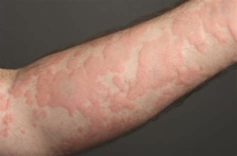 Urticaria (Hives) - Definition, Symptoms, Diagnosis, Treatment ...