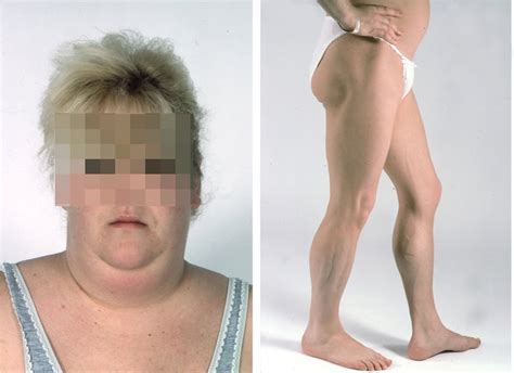 An inherited (genetic) disorder characterized by absence of fat cells. Endócrino News: Lipodistrofias