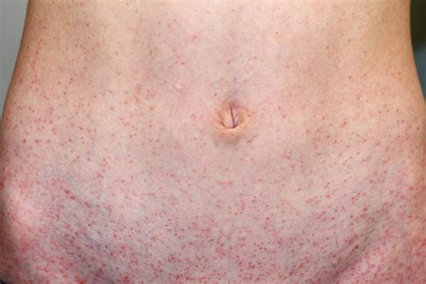 Having a rash is usually not fatal, however it will temporarily reduces the players sanity as long as the rash persists. Petechial rash with parvovirus infection | The BMJ