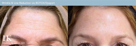 These wrinkles, with their slightly negative name, run straight down. Can Starting Botox Treatment Early Prevent Wrinkles?