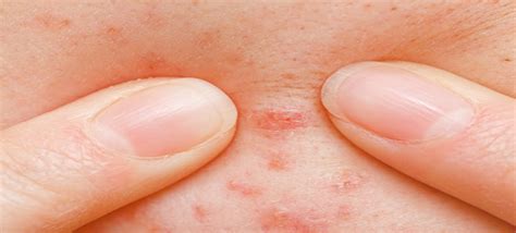 Die röte eines pickels weist auf eine entzündliche reaktion hin und nicht auf eine narbe. Krankhaftes Pickel drücken - Skin Picking!? | doktor-haut.de